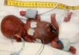 معجزه زنده ماندن کوچک ترین نوزاد متولد شده در دنیا