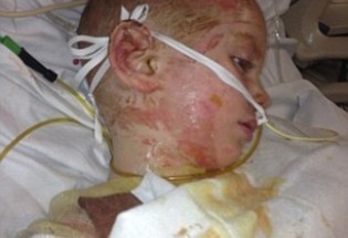 پسری با دردناک ترین بیماری پوستی +عکس