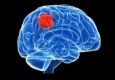 نشانه‌هایی که خبر از تومور مغزی می‌دهند