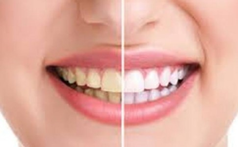 ۳ دقیقه ای دندان‌های خود را سفید کنید