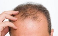 سفید شدن مو در سنین زیر 40 سال بیماری است/ درمان ریزش مو با روش های طب سنتی