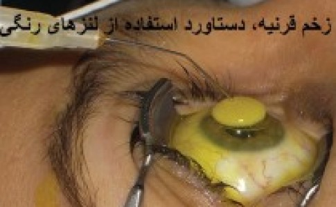 زخم قرینه دستاورد استفاده از لنزهای رنگی/ از تهدید سلامت شهروندان تا فروش غیربهداشتی لنز در زاهدان