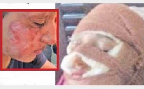 بادکنک صورت دختری را در روز تولدش زشت کرد