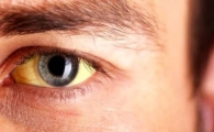 زردی چشم چه زمانی خطرناک می‌شود؟