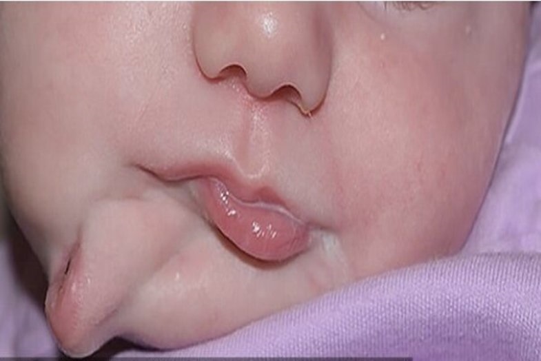 در یک مورد بسیار نادر، نوزادی با دو دهان متولد شد +عکس