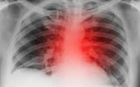 کاهش خطر بیماری قلبی با زندگی در مناطق سرسبز