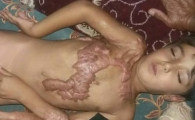 سوختگی پسر ۴ ساله سیستانی با آب جوش/فقر مانع درمان ابوالفضل شد
